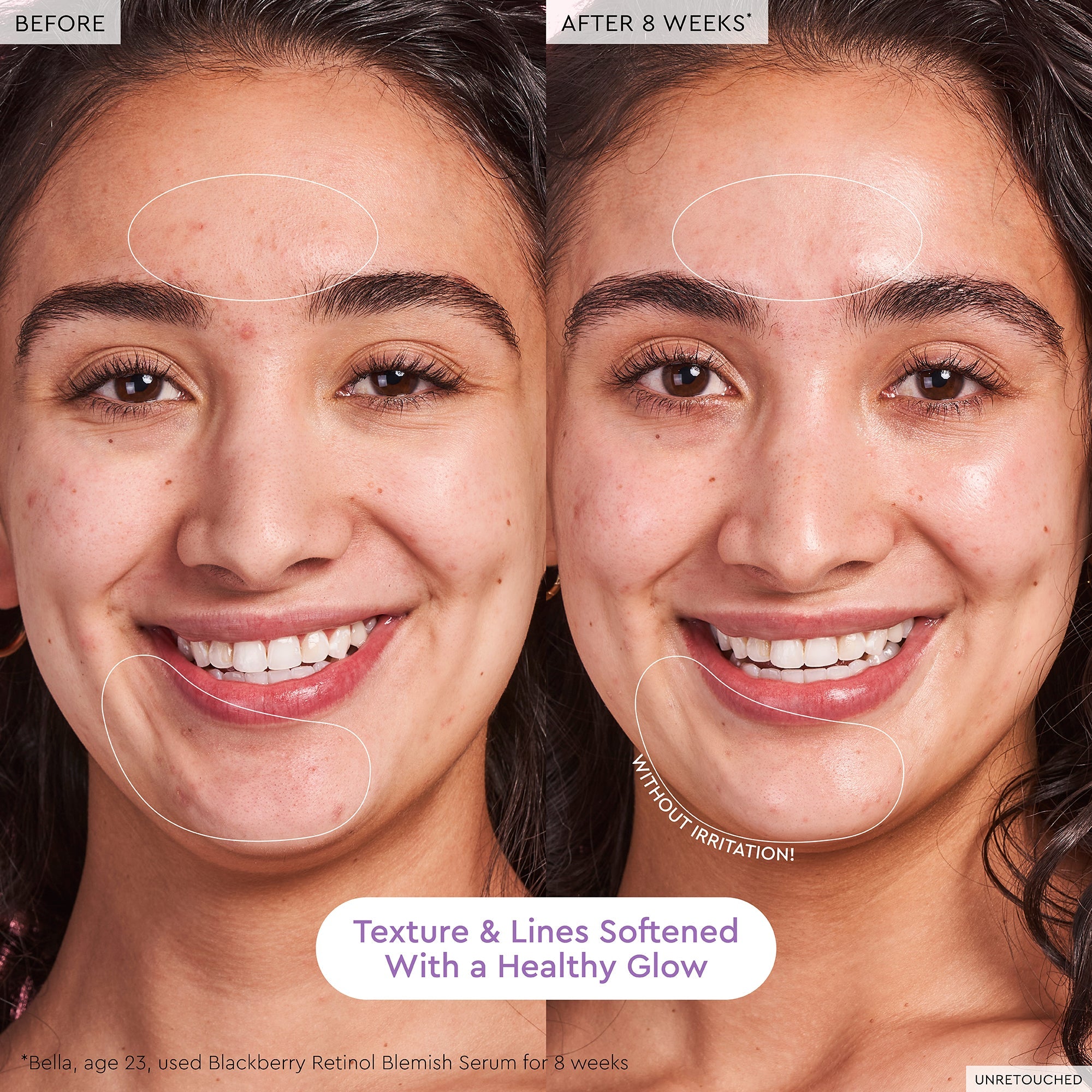 Before-and-after photo of a 23-year-old using Glow Recipe Blackberry Retinol Blemish Serum showing clearer, less discolored skin.