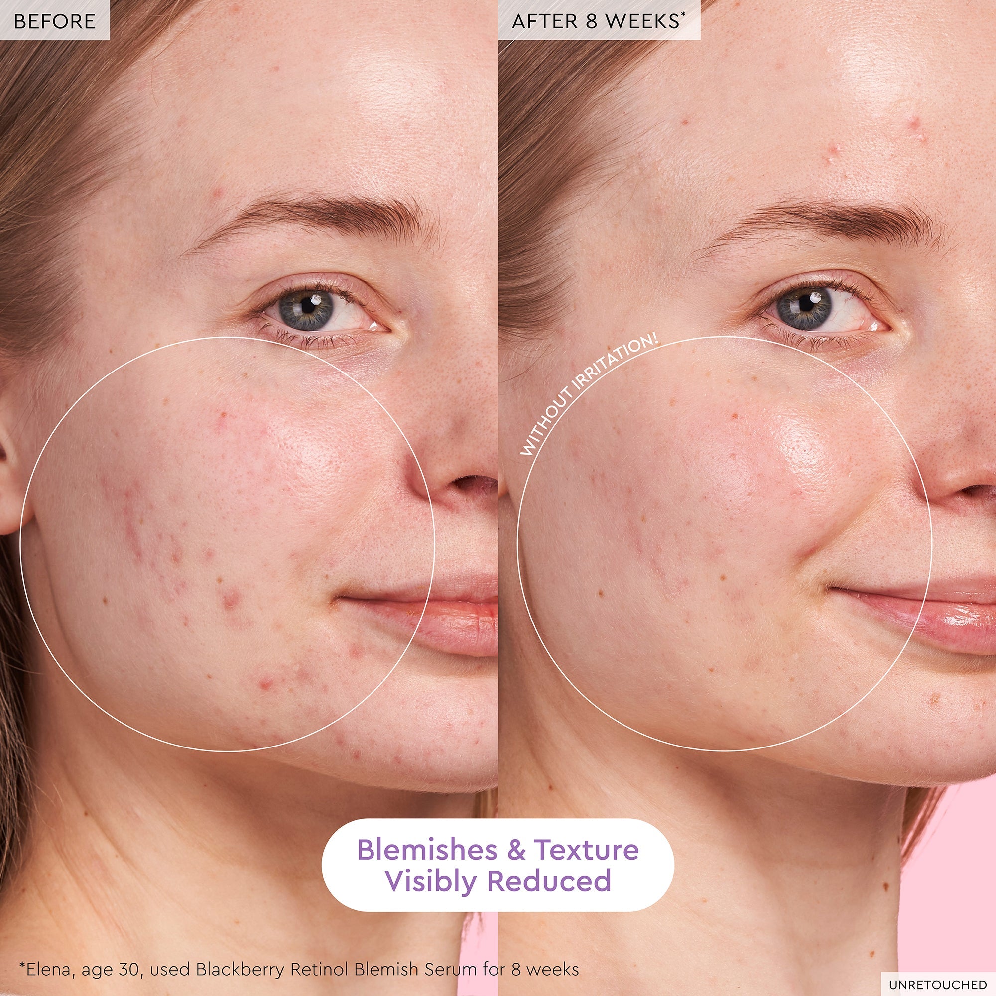 Before-and-after photo of a 30-year-old using Glow Recipe Blackberry Retinol Blemish Serum, showing clarified, even-toned skin.