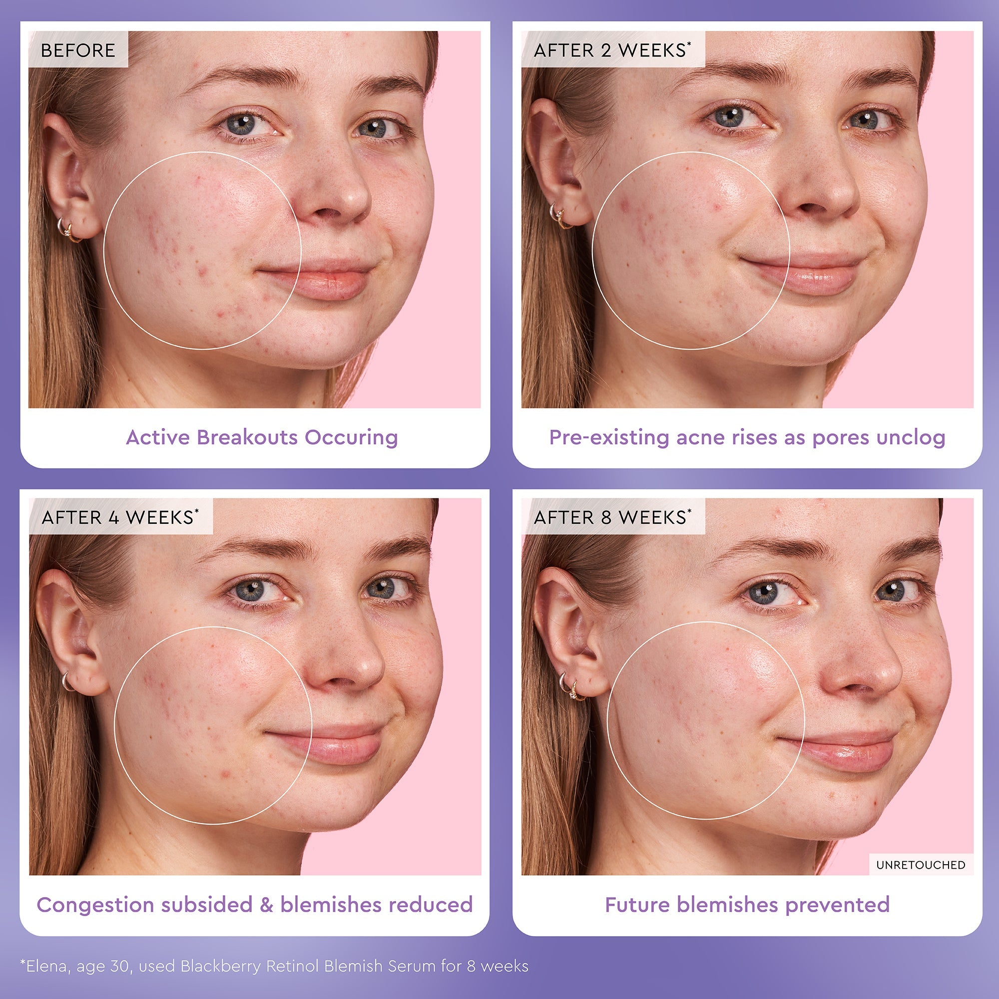 Before-and-after progression timeline of a 30-year-old's skin while using Glow Recipe Blackberry Retinol Blemish Serum.